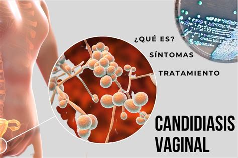 infeccion vajinal fotos reales|Candidiasis vaginal: imágenes, causas, síntomas y tratamiento